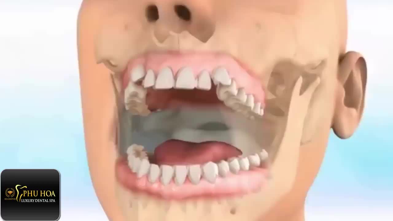 Mô phỏng niềng răng điều trị khớp cắn ngược (móm)