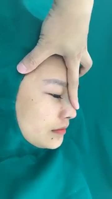 Phân tích dáng mũi - kết quả ngay sau nâng mũi