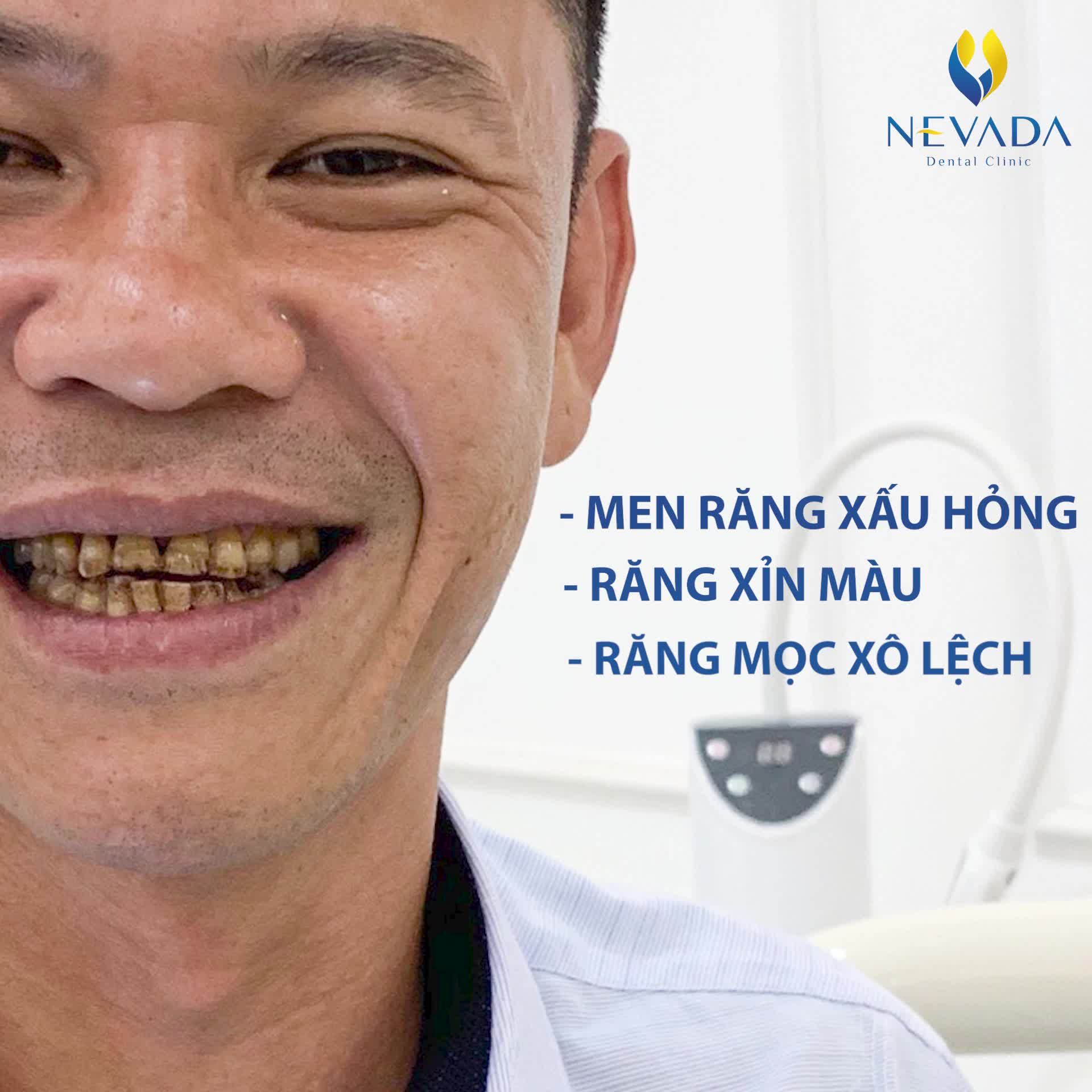 TÁI SINH NỤ CƯỜI VỚI 20 RĂNG SỨ ZIRCONIA CAO CẤP