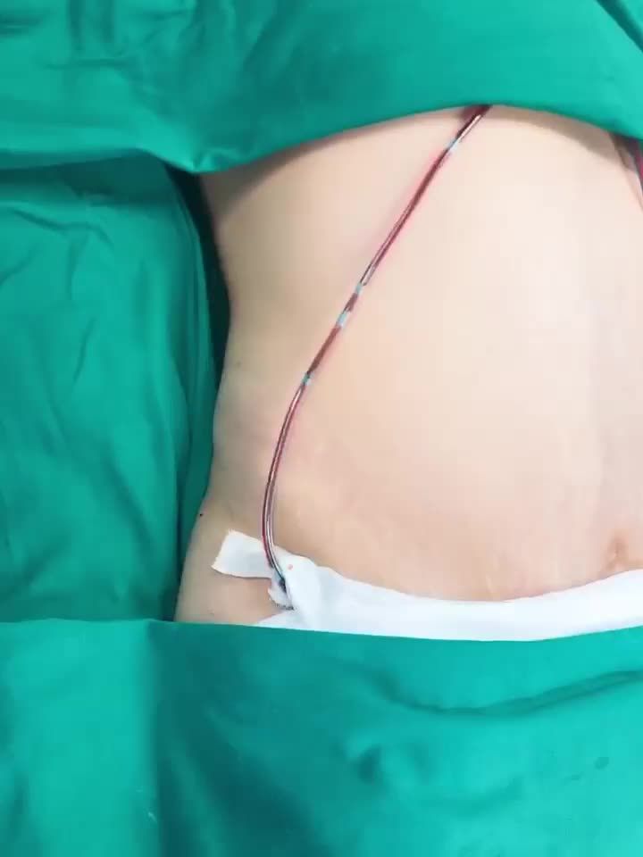 XÓA SỔ BỤNG BỰ TRONG TÍCH TẮC, BÀ MẸ 2 CON LẤY LẠI VÒNG EO NHƯ HỒI 18