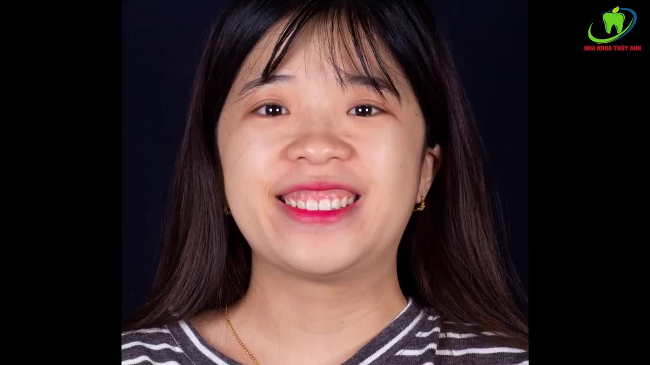 HOÀN THIỆN NỤ CƯỜI CHẠM TỚI ƯỚC MƠ BẰNG PHƯƠNG PHÁP PHẪU THUẬT CƯỜI HỞ LỢI