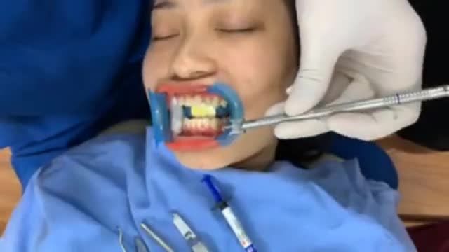 Gắn mắc cài cho bạn Phương tại Nha Khoa Thùy Anh.