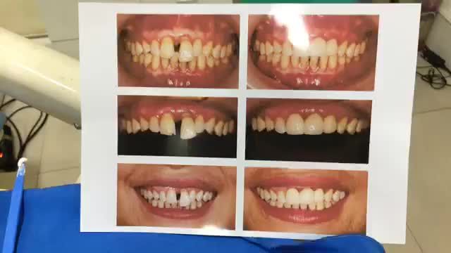 Lắp răng sứ thẩm mỹ tại Nha Khoa Thuỳ Anh.