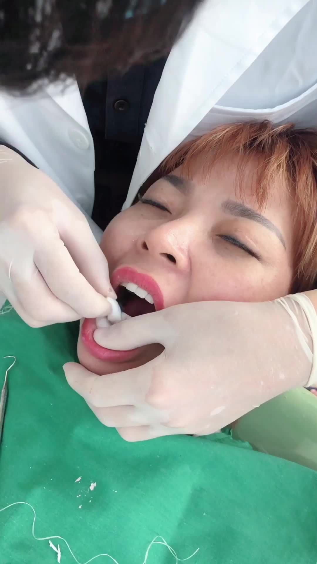 DÁN SỨ VENEER KHÔNG MÀI NHỎ TẠI NHA KHOA GIA ĐÌNH