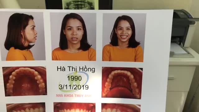 Gắn mắc cài tại Nha Khoa Thuỳ Anh.