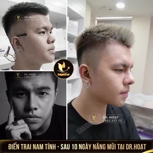 ĐIỂN TRAI NAM TÍNH SAU 10 NGÀY NÂNG MŨI CẤU TRÚC TẠI DR.HOẠT