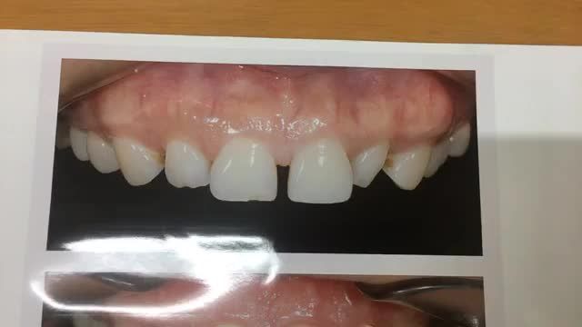 Lắp 4 răng cửa thẩm mỹ cải thiện răng thưa, răng dị dạng tại Nha Khoa Thuỳ Anh.