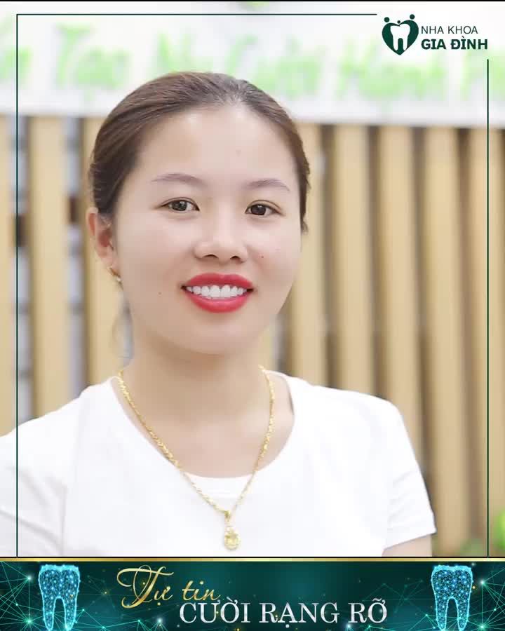 GỠ RỐI HÀM RĂNG CHƯA ĐẸP, Ố VÀNG NHỜ PHƯƠNG PHÁP DÁN SỨ VENEER