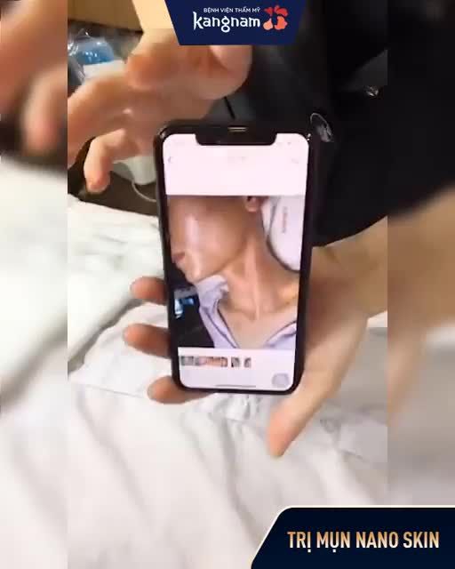Bị MỤN đã 3-4 năm không khỏi, tới Kangnam trị 4 buổi đã bay mụn tới 90%