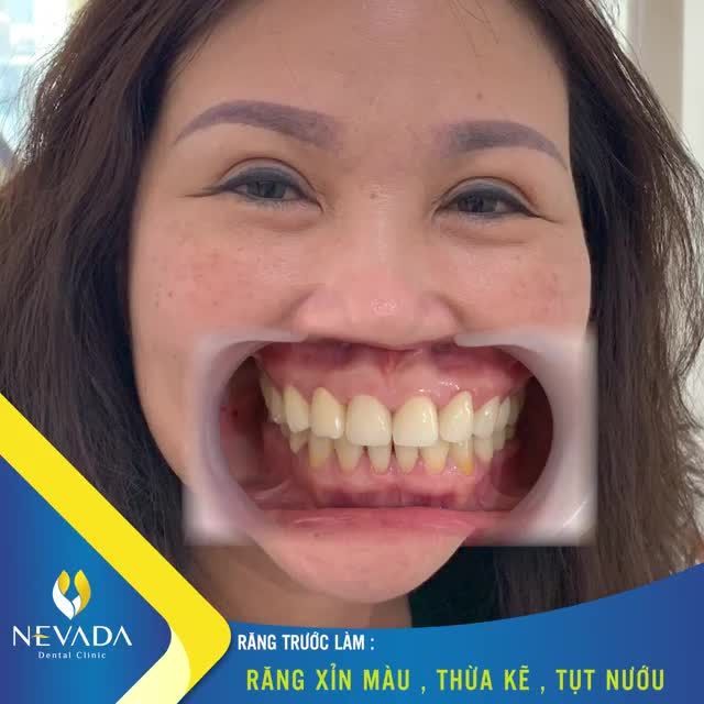 2 BUỔI HẸN  MÀN LỘT XÁC NGOẠN MỤC