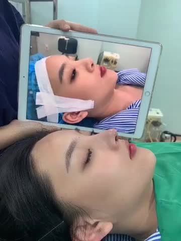 3 LẦN SỬA MŨI KHÔNG THÀNH CÔNG TỚI LATIN CÓ MŨI ĐẸP XUẤT THẦN