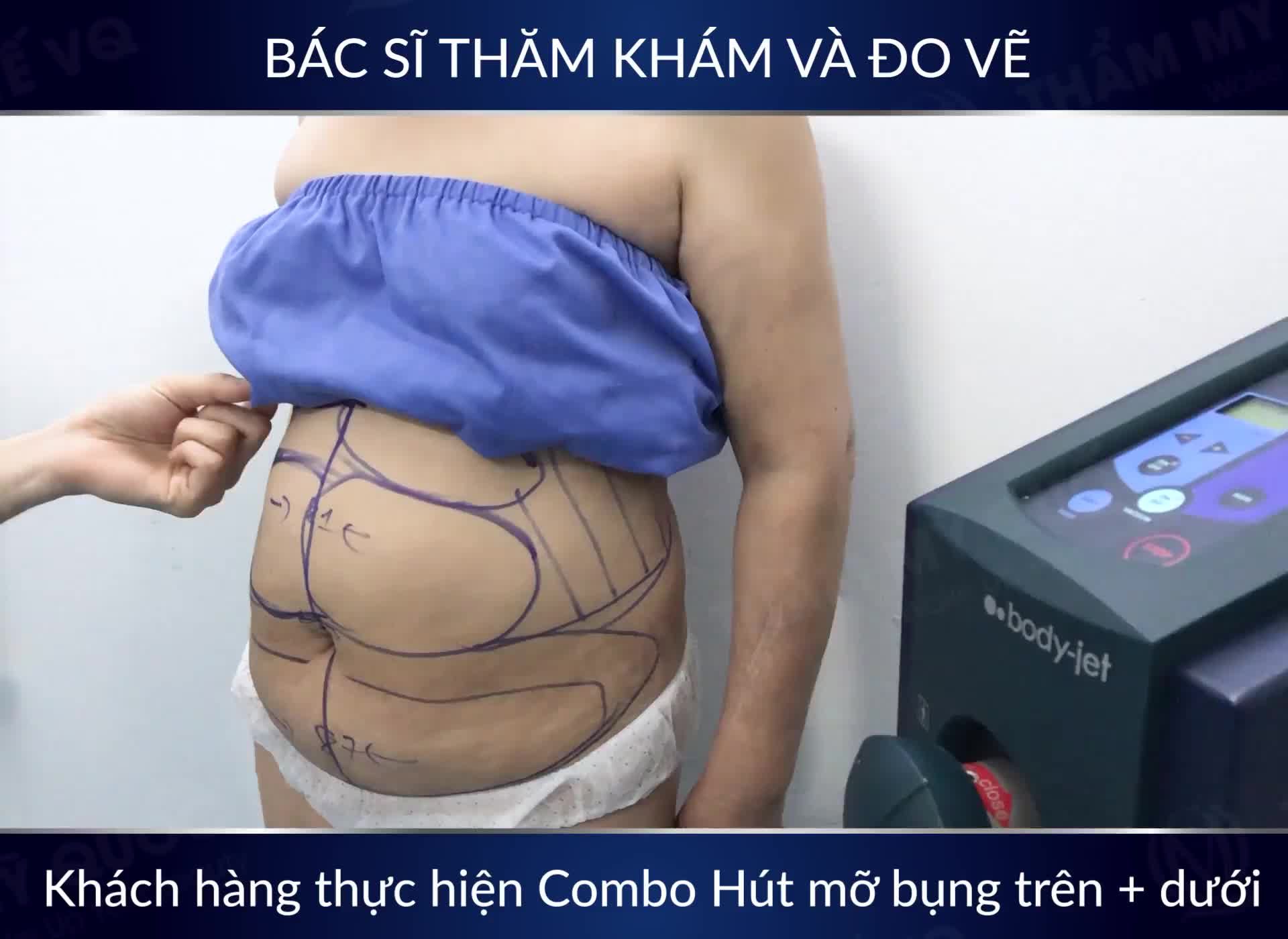 Bác sĩ thăm khám và đo vẽ cho chị khách hàng thực hiện COMBO Hút mỡ bụng trên và dưới!