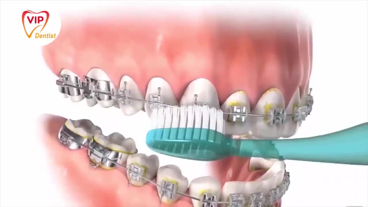 Bí quyết sạch sẽ của hàm răng gắn mắc cài
