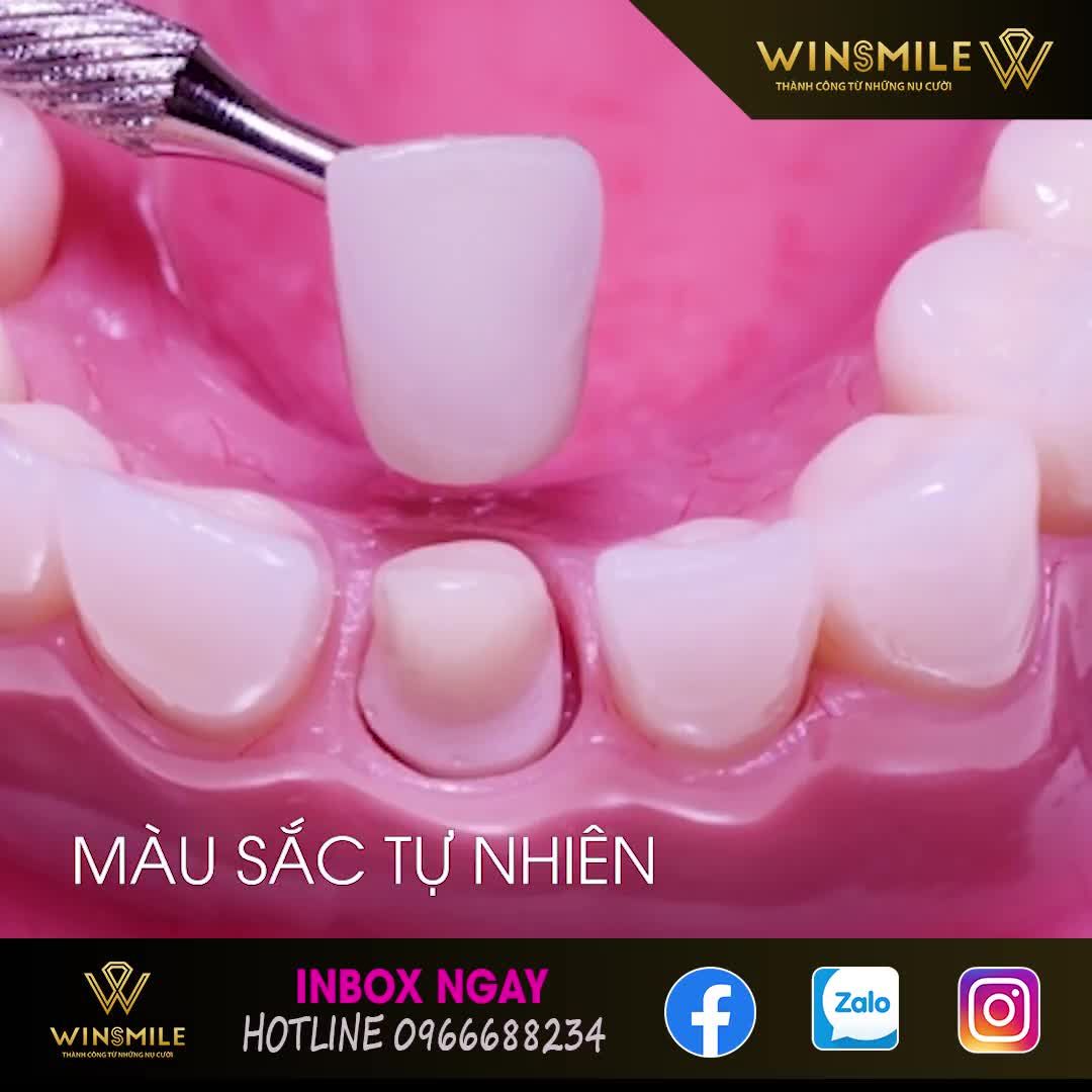 Bọc Răng Sứ Veneer không cần mài răng là một phương pháp mới, giúp bảo toàn răng thật một cách trọn vẹn khi bọc răng