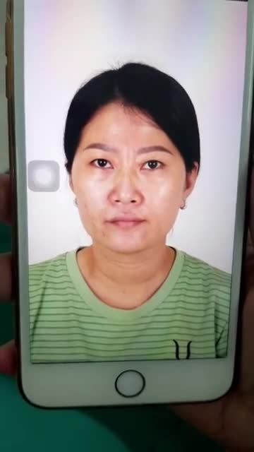 Cắt mắt total tại Saigon Venus vừa xong luôn cả nhà ơi.