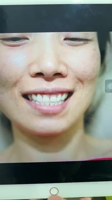 Thẩm mỹ răng sứ mang lại nụ cười đẹp hoàn hảo - thoải mái ăn nhai