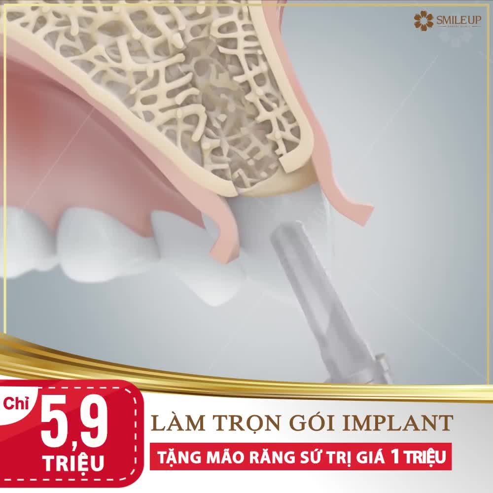 TRỒNG RĂNG 1 LẦN - DÙNG TRỌN ĐỜI