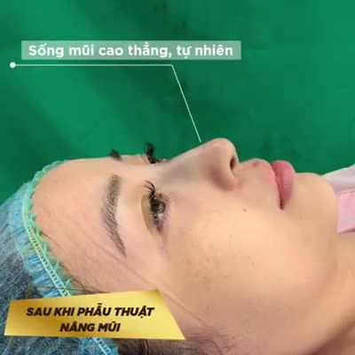 1 CA NÂNG MŨI MESHAPE CỦA KHÁCH HÀNG ĐẸP KHÔNG TỲ VẾT