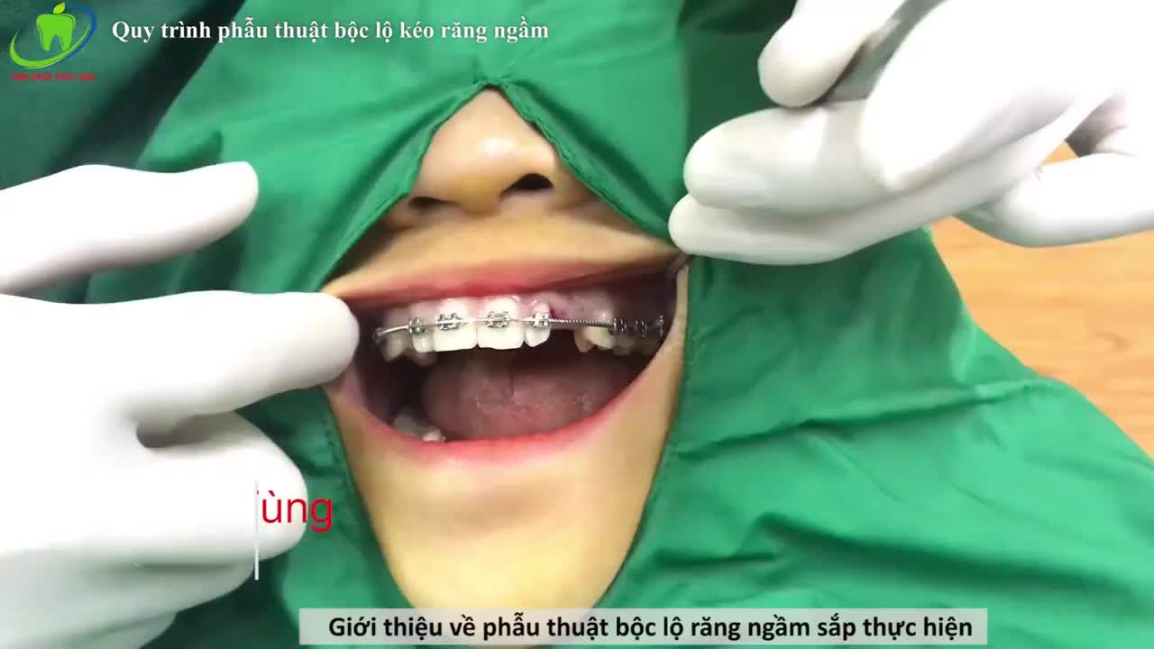 NIỀNG RĂNG - KÉO RĂNG NGẦM TÌM LẠI NỤ CƯỜI VỐN CÓ