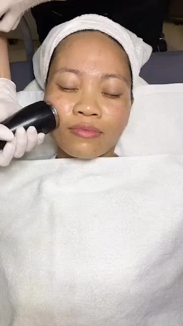 “Quét sạch mụn” sau 5 buổi điều trị mụn Nano Skin