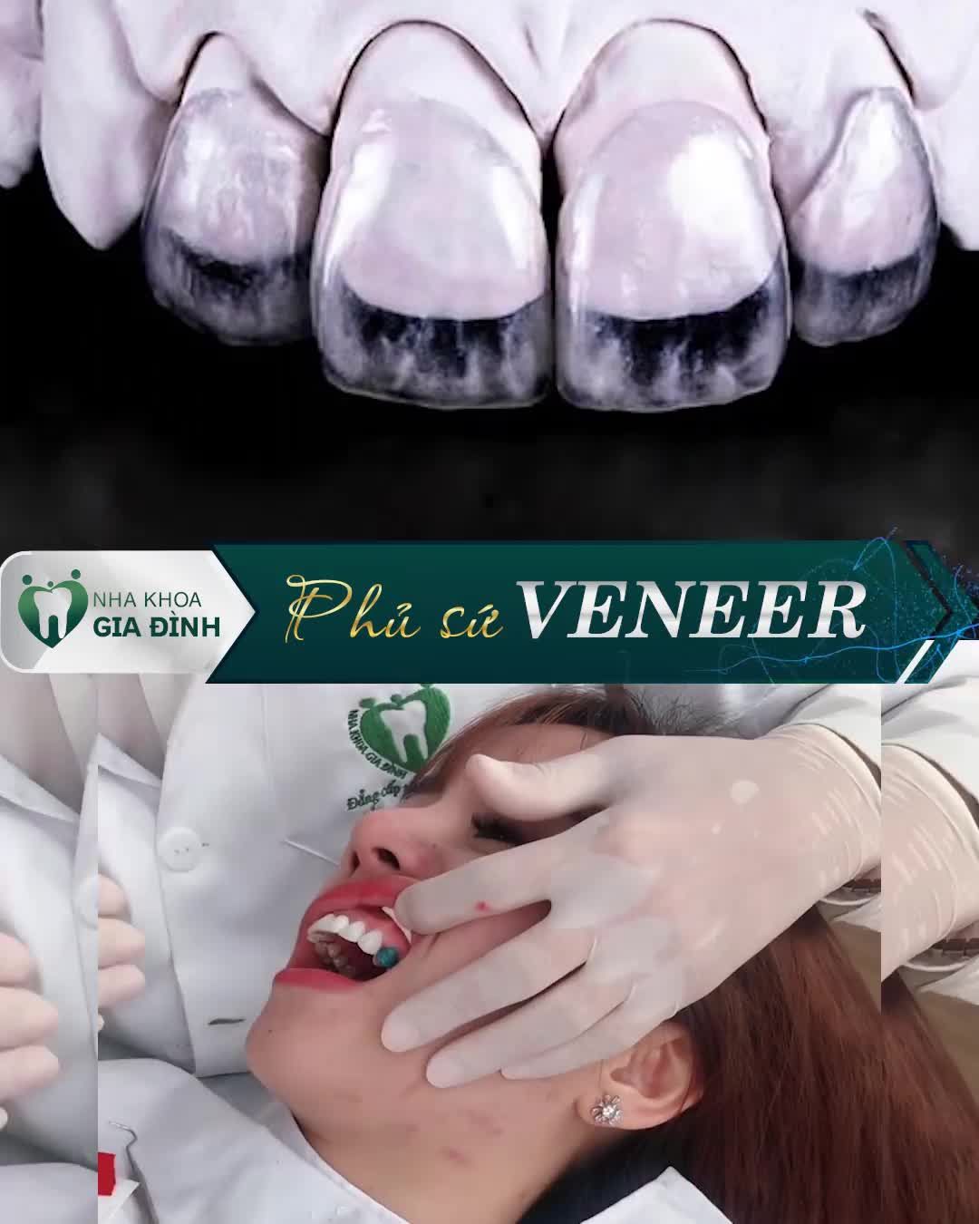 VENEER SIÊU MỎNG  KHÔNG CẦN MÀI RĂNG TẠI NHA KHOA GIA ĐÌNH