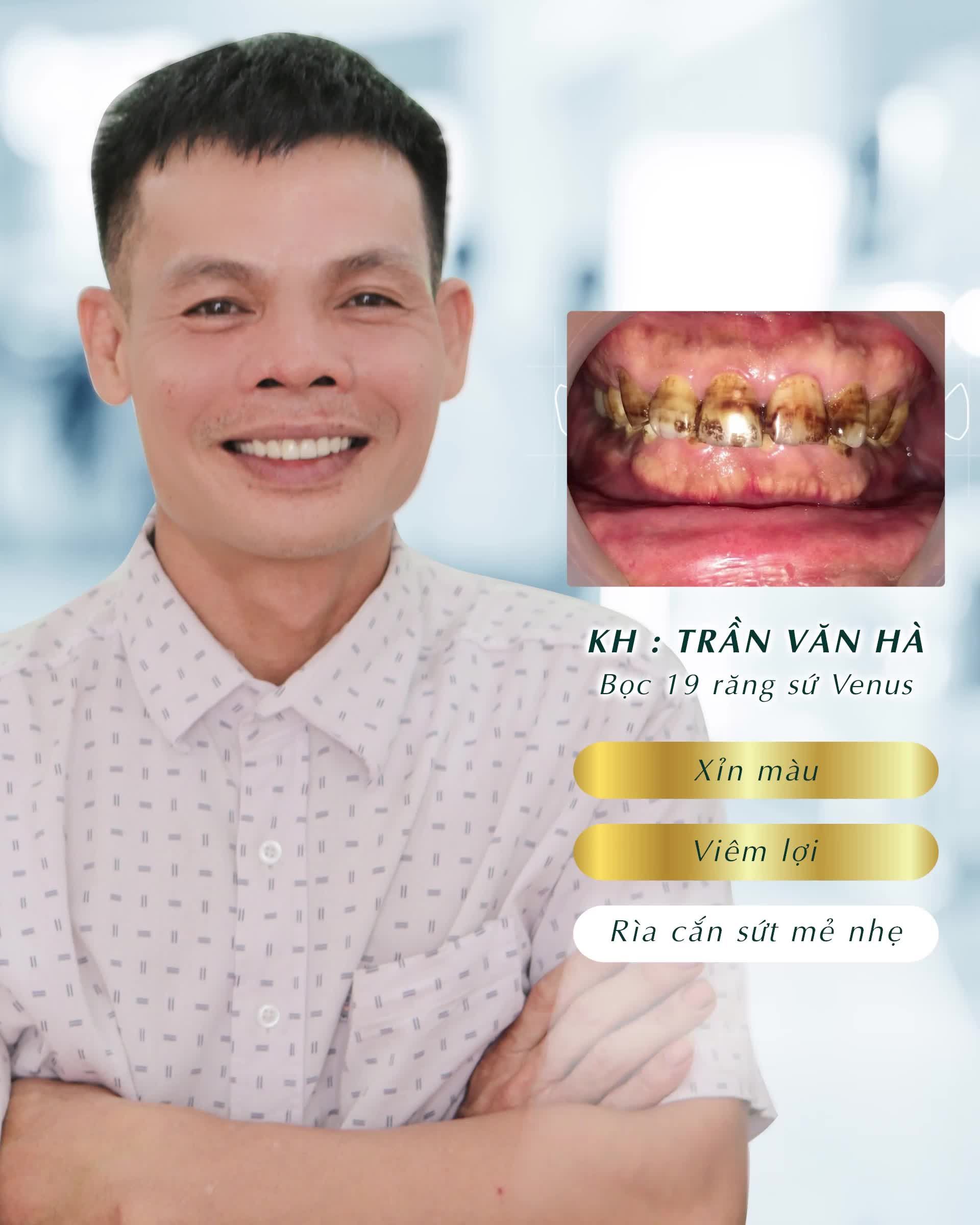 THẨM MỸ RĂNG – TỰ TIN CUỐN HÚT – ĐẸP HƠN TƯỞNG TƯỢNG