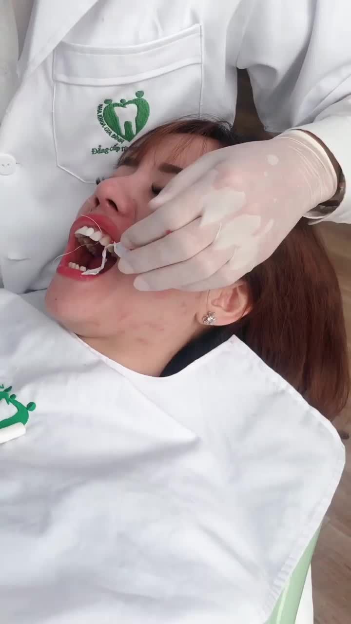 Dán Sứ Veneer Bảo Tồn Răng Gốc - Giữ Nguyên Răng Thật - Không ê buốt tại Nha khoa Gia Đình