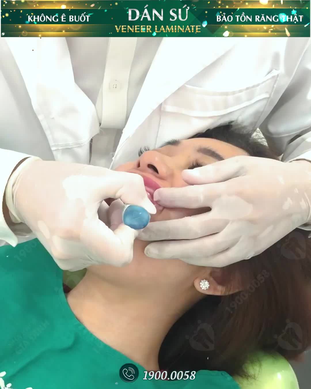 DÁN SỨ VENEER: BẢO TỒN RĂNG THẬT – KHÔNG ĐIỀU TRỊ TỦY