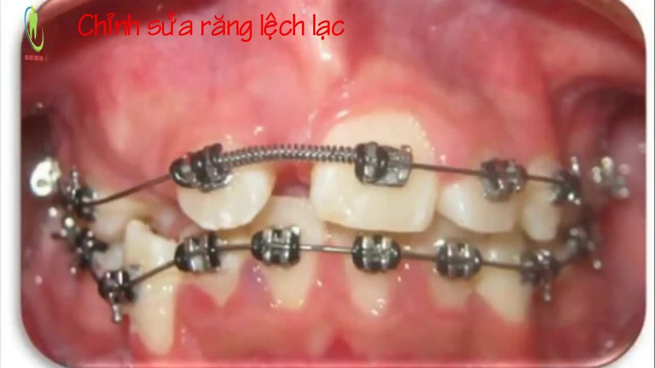 MÔ PHỎNG QUÁ TRÌNH NIỀNG RĂNG ĐIỀU TRỊ RĂNG LỆCH LẠC, KÉO RĂNG NGẦM TẠI NHA KHOA THÙY ANH.