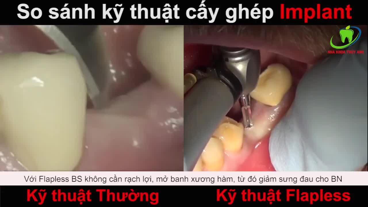 CẤY CHÂN RĂNG NHÂN TẠO IMPLANT THƯỜNG QUY VÀ KỸ THUẬT KHÁC NHAU NHƯ NÀO