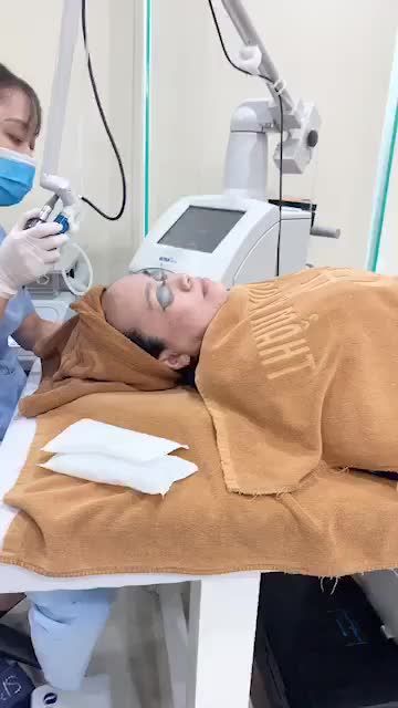 Cận cảnh 1b điều trị Sẹo Rỗ do mụn viêm để lại với laser Ultrapulse !