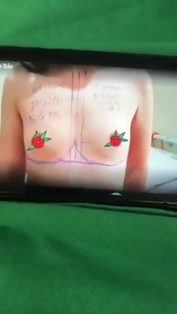 KẾT QUẢ NÂNG NGỰC NANO CHIP