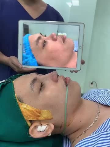 Mũi cấu trúc cho nam giới
