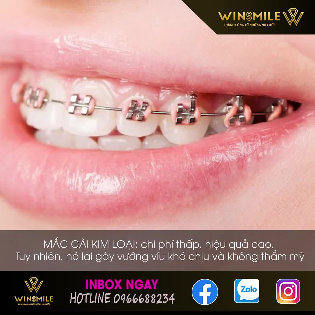 NIỀNG RĂNG - CHỈ CÓ LỢI MÀ KHÔNG HỀ CÓ HẠI