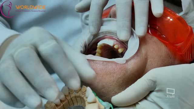 ZOOM - IN CASE KHÁCH HÀNG GẮN RĂNG SỨ NGỌC TRAI TẠI Nhakhoadrhung với sự theo dõi và tỉ mỉ đến từng chi tiết của Bác sĩ. Minh Trí.