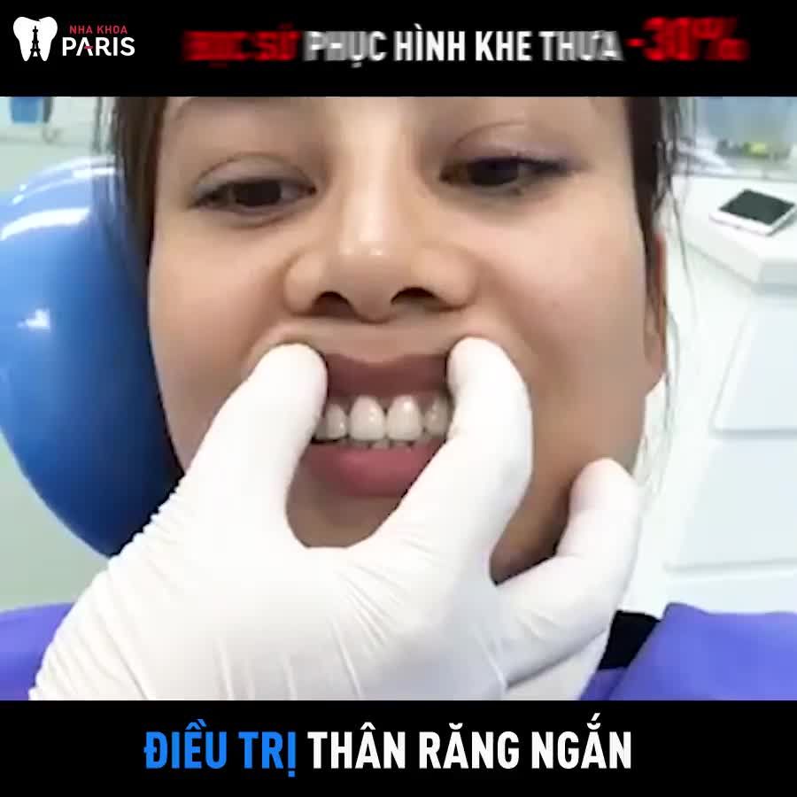 Kết Quả Phục Hình Sứ 02 Răng Cửa