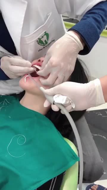 PHỦ MÀNG SỨ VENEER SIÊU MỎNG - KH Phạm Thị Ngọc Vân tại chi nhánh Trần Thái Tông.