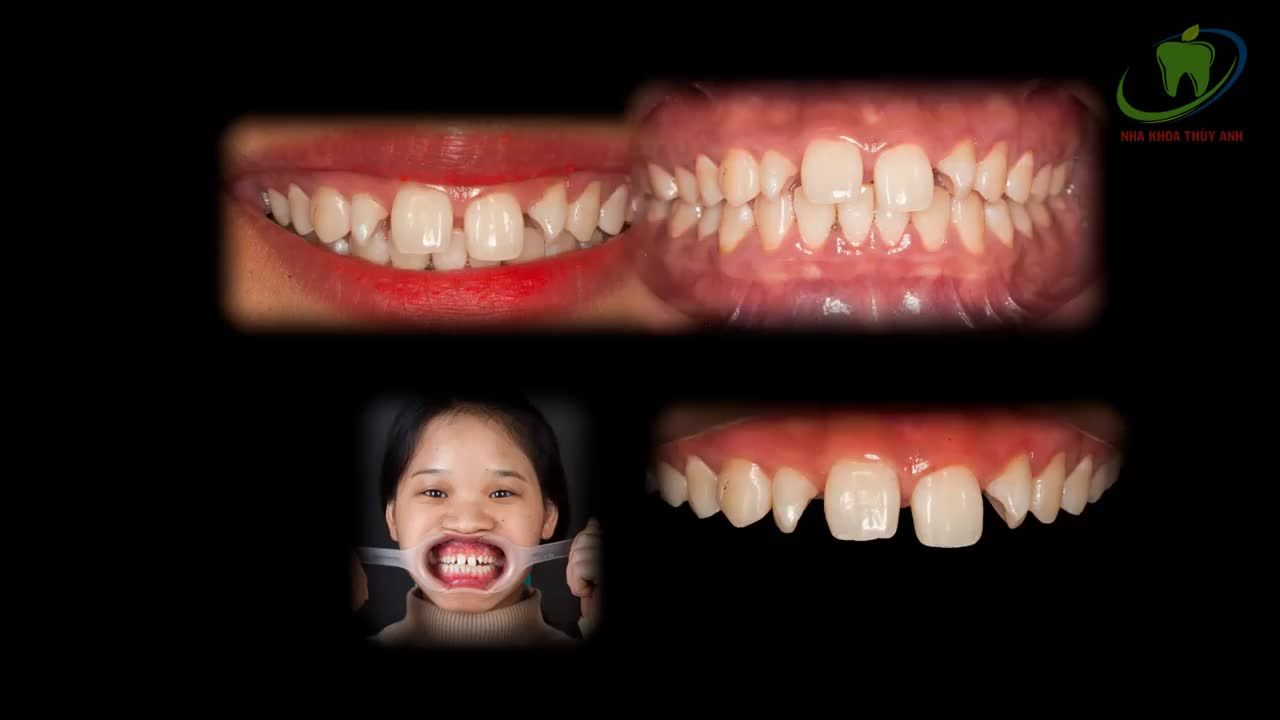 NẾU RĂNG BẠN XẤU, LỆCH LẠC NHẸ, THƯA NHƯNG KHÔNG MUỐN NIỀNG RĂNG THÌ BỌC RĂNG SỨ ĐANG LÀ PHƯƠNG PHÁP CHỈNH SỬA TỐT NHẤT HIỆN NAY.