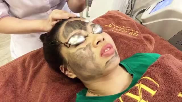 CẬN CẢNH CA TRỊ MỤN THÀNH CÔNG NGOÀI MONG ĐỢI TẠI VTM DR.HẢI LÊ