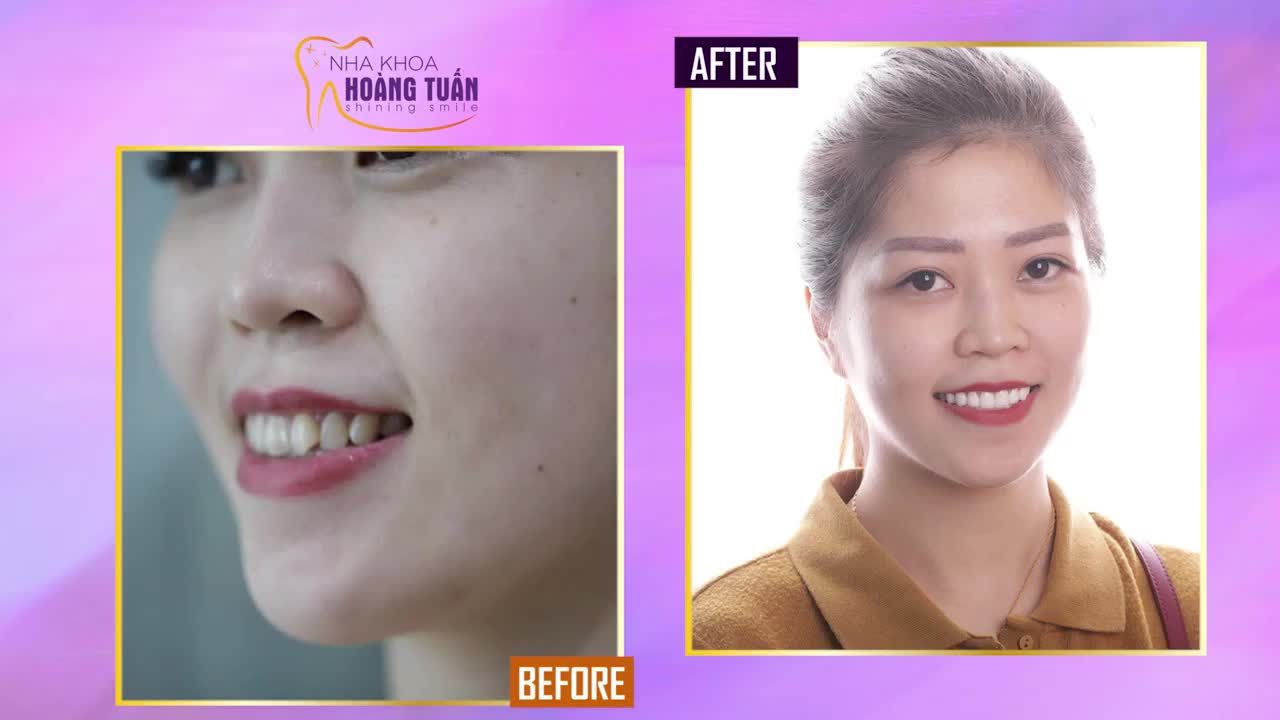 Nha khoa Hoàng Tuấn tổng hợp hình ảnh tình trạng trước và sau khi thay đổi của 3 khách hàng bằng phương pháp phục hình răng sứ thẩm mỹ.