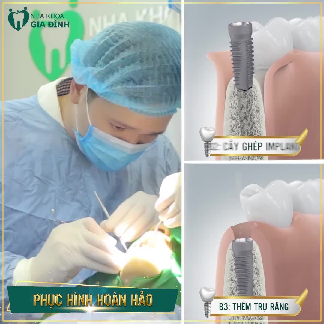 CẤY GHÉP IMPLANT NOBEL BIOCARE PHỤC HÌNH RĂNG MẤT HOÀN HẢO