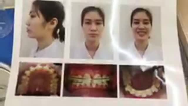 Ca tháo mắc cài - kết thúc điều trị niềng răng cho chị Vân tại Nha Khoa Thuỳ Anh.