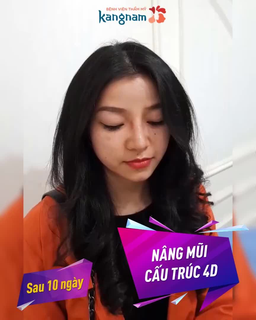 Chia tay mũi thấp tẹt, nữ khách hàng xinh đẹp "xuất sắc" sau 10 ngày Nâng mũi cấu trúc 4D