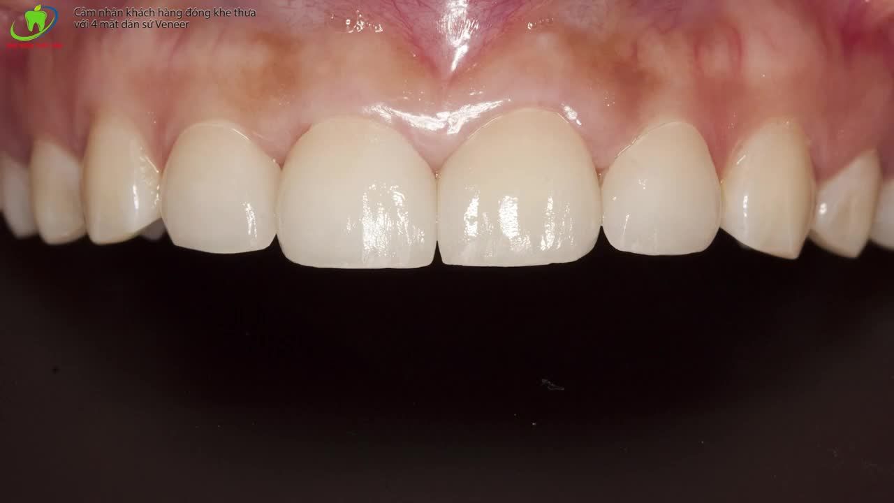 DÁN SỨ VENEER AN TOÀN NGAY TẠI NHA KHOA THÙY ANH