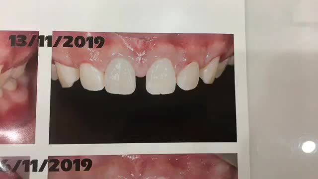 Gắn cố định 6 chụp sứ khắc phục răng thưa, hình thể k đều cho bạn Huy đến từ Bắc Giang.