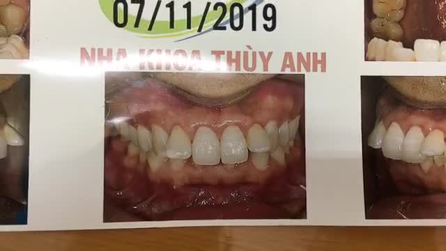 Gắn mắc cài cho khách hàng tại Nha khoa Thùy Anh.