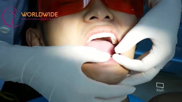 Case nam khách hàng đặc biệt trong tình trạng mất răng bẩm sinh, ăn nhai khó khăn đến với Nhakhoadrhung.
