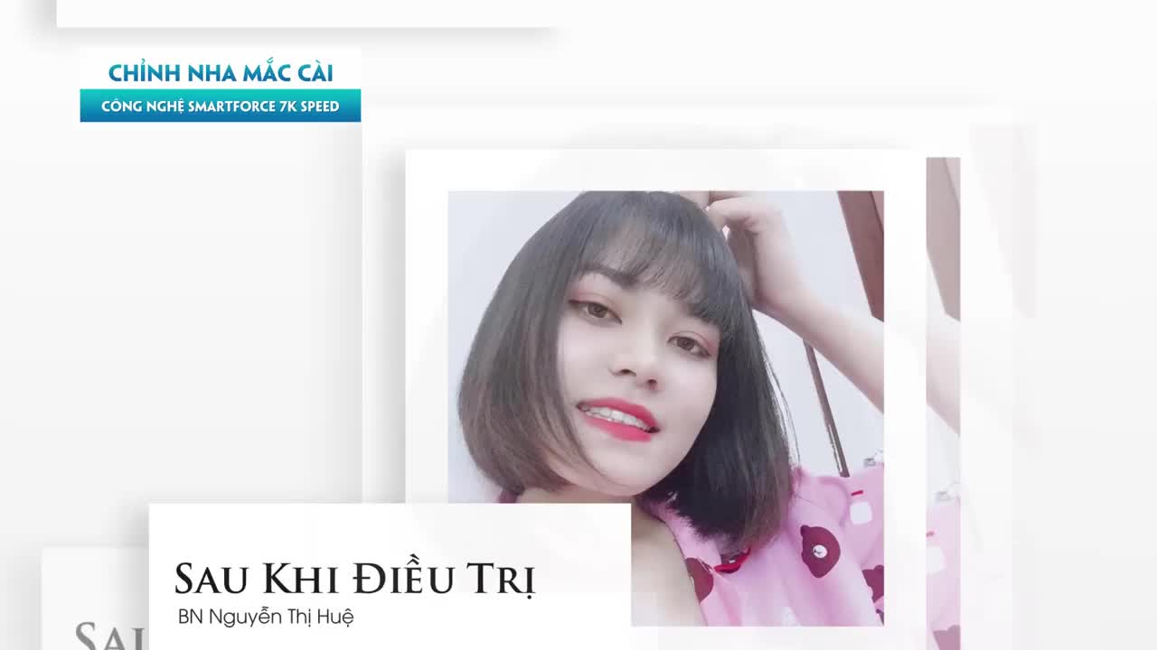 LỘT XÁC NHỜ NIỀNG RĂNG - ĐIỀU TRỊ RĂNG HÔ NẶNG VÀ THƯA