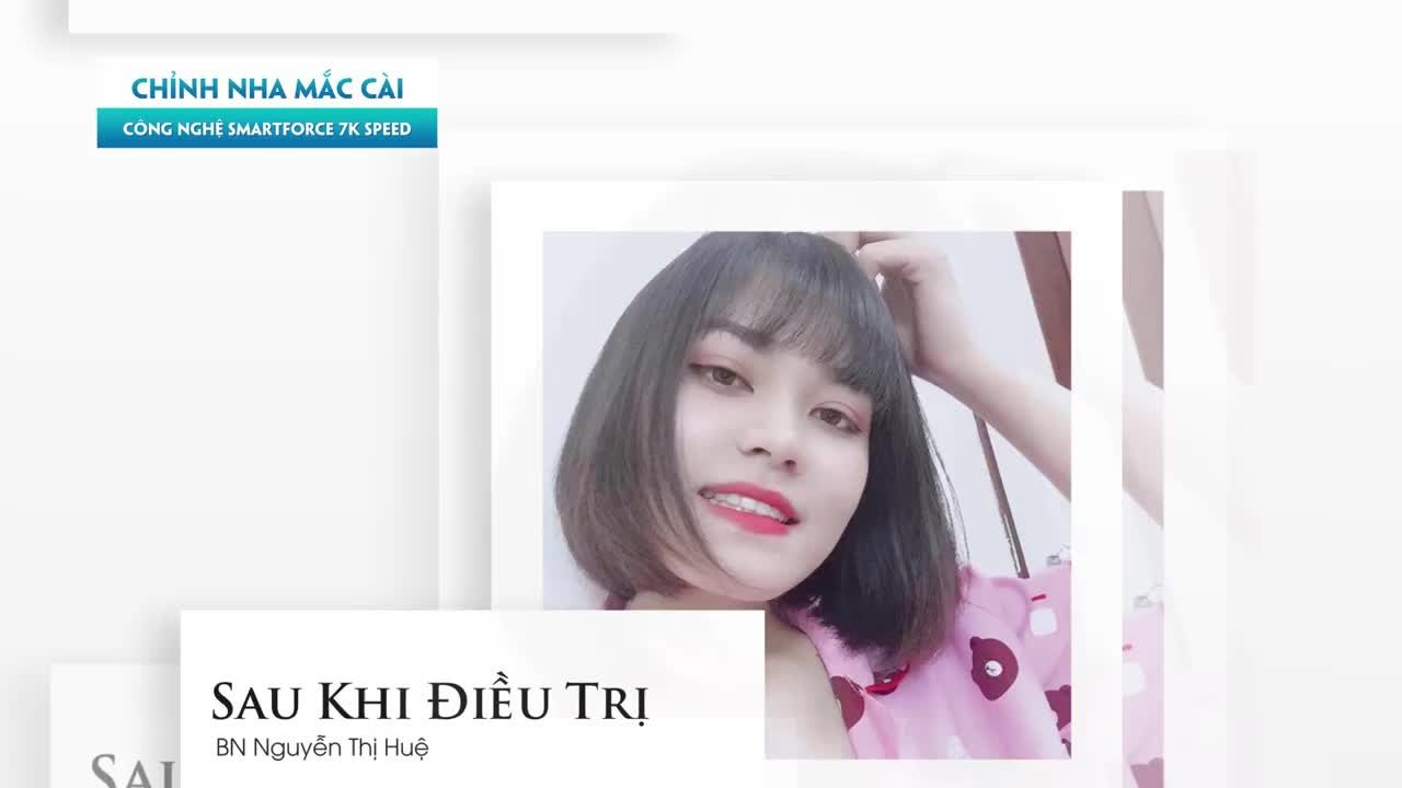 LỘT XÁC NHỜ NIỀNG RĂNG - ĐIỀU TRỊ RĂNG HÔ NẶNG VÀ THƯA
