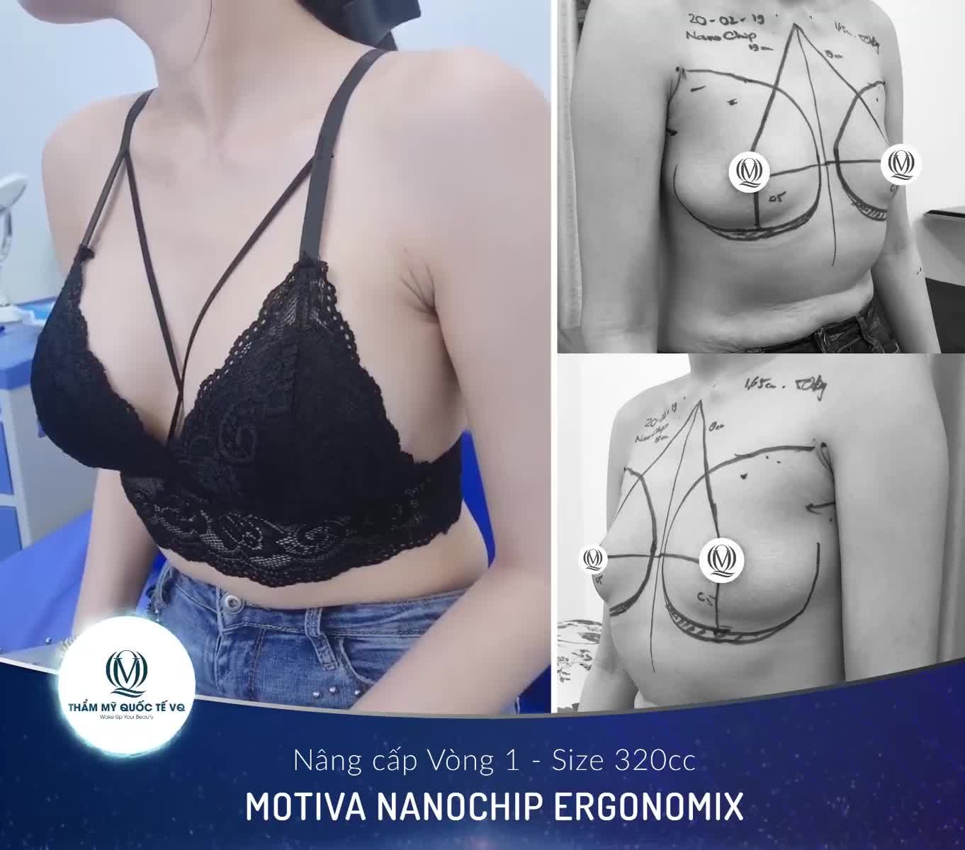 Mời cả nhà cùng chiêm ngưỡng kết quả rất thành công của ca Nâng cấp V1 túi Motiva Nanochip Ergonomix size 320cc nhé!